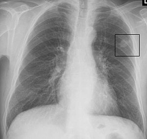 Chest x-ray showing a lung tumor. Photo credit: Lange123, Creative Commons via Wikimedia Common
